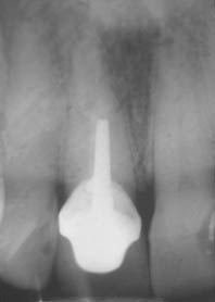 Fig.1 : Radiogramme rétro-avéolaire montrant la fêlure à la pointe du tenon métallique en mésial à mi-hauteur radiculaire.