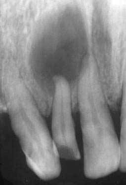 Fig.12 : Radiographie rétro alvéolaire visualisant une image radio claire bien limitée  avec un liseré d’ostéo condensation englobant les racines de la 11 et 12