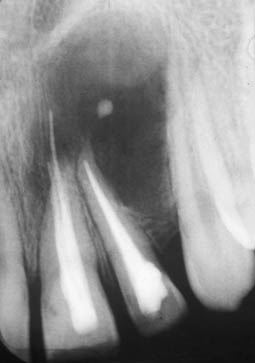 Fig.13 :  Radiographie rétro-alvéolaire montrant des images radio claires avec un liseré moins dense en rapport avec les 21 et 22. Même cas clinique que fig. 11