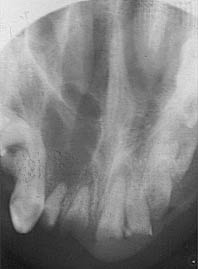 Fig.14 : Image radiologique montrant l’aspect multiloculaire d’un kyste péri apical