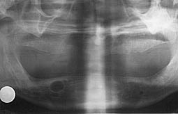 Fig.15 : Radiographie panoramique visualisant un kyste résiduel mandibulaire