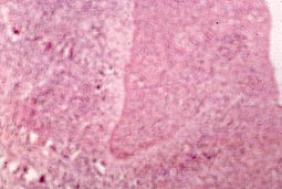 Fig.16 :  Aspect histologique d’une lésion inflammatoire type kyste radiculo-dentaire