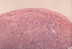 Fig.17 : Aspect histologique d’un kyste résiduel