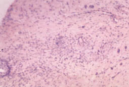 Fig.18 :  Aspect histologique d’un kyste folliculaire