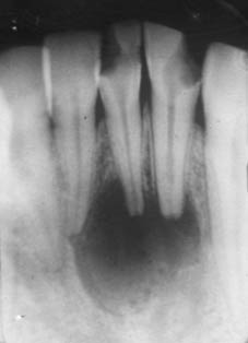 Fig.3 : Radiographie rétro alvéolaire révélant un kyste radiculodentaire en rapport avec les racines des 31 et 32 Fig.3 : Radiographie rétro alvéolaire révélant un kyste radiculodentaire en rapport avec les racines des 31 et 32