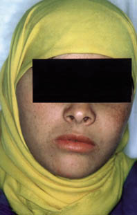 Fig.6 : Patiente consultant pour une tuméfaction génienne haute maxillaire gauche