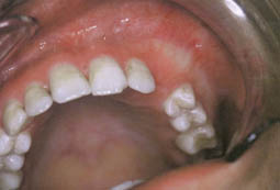 Fig.7 : Même cas que figure 6 ; à l’examen endobuccal,  tuméfaction vestibulaire en regard de la 23 absente sur l’arcade