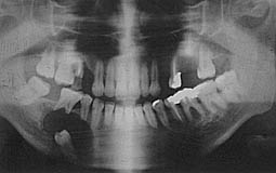 Fig.8 : Radiographie panoramique visualisant la présence d’un kyste folliculaire en rapport avec la 45 incluse Noter la résorption radiculaire des 44 et 46