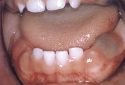 Fig.9 : Aspect clinique d’un kyste d’éruption chez l’enfant