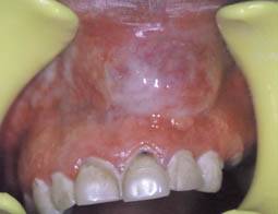 Aspects Cliniques Et Anatomopathologiques Des Kystes Odontogenes Dossiers Du Mois Aspects Cliniques Et Anatomopathologiques Des Kystes Odontogenes Dossiers Du Mois