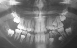 Fig.2 : Radiographie panoramique montrant un kyste folliculaire  en rapport avec les racines des molaires temporaires cariées et englobant les germes des 34 et 35