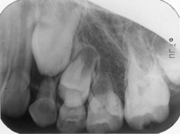 Fig. 2 : Cliché rétro-alvéolaire montrant l’absence du germe de la 25. Noter la présence discrète en distal de la racine de la 24 d’un sac folliculaire vide