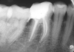 Fig. 4 : Obturation au thermafil d’une molaire inférieure présentant une courbure au niveau de la racine mésio-linguale