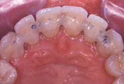 Fig.10 :  Vérification de l’occlusion après finition