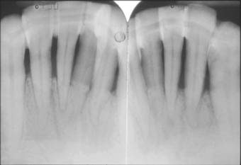 Fig. 2 :  Radiographies montrant la contention des dents parodontalement atteintes