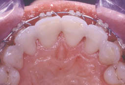 Fig. 3 :  Contention post orthodontique de 13 à 23
