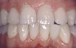 Fig. 4a  :  Remplacement de 32 par dent en composite et CRF (1)