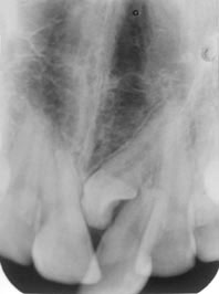 Fig. 1 : Rétro-alvéolaire montrant une dent surnuméraire située entre les deux incisives centrales supérieures Fig. 1 : Rétro-alvéolaire montrant une dent surnuméraire située entre les deux incisives centrales supérieures