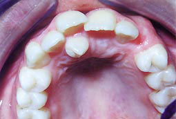Fig. 3 :  Dent surnuméraire située en dehors de l’arcade. Il s’agit d’un mesiodens de forme conoïde situé derrière les incisives maxillaires