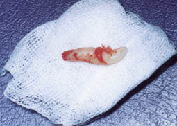 Fig. 4 : Dent surnuméraire extraite . La racine et la couronne  parfaitement formées