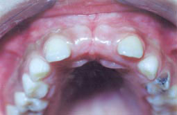 Fig. 6a : Vue endo buccale : un petit patient de 9 ans présentant un retard  d’évolution des incisives centrales supérieures  permanentes