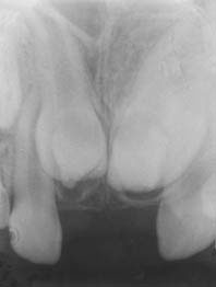 Fig. 6b : La rétro-alvéolaire montrant la présence de deux dents surnuméraires  causant la  rétention de la 11 et de la 21