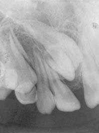 Fig. 7b :  Au vue de la rétro alvéolaire la 11 est retenue par un mesiodens. La décision thérapeutique a été l’extraction de la 11 et du mesiodens avec conservation de la dent surnuméraire de forme anatomique normale. L’orthodontie permettra la correction des malpositions