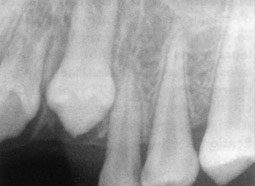 Radiographie 2Agénésie dentaire 2