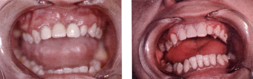 Fig 4: Cas clinique N°3 Avant / Après