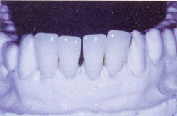 Fig 9: Modèle coulé en plâtre avec les dents montées