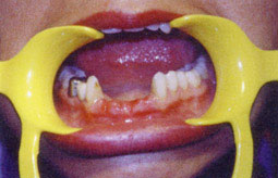 Fig 11: Extraction des dents