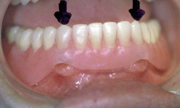 Fig. 7 : Repérage en bouche de l’emplacement des coiffes sur l’extrados de la prothèse
