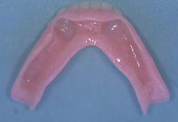 Fig. 6 :  Prothèse totale mandibulaire réalisée selon la technique classique