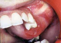 Fig. 2 : Aspect endobuccal : tuméfaction du maxillaire gauche allant de la 23 à la 27 comblant le sillon vestibulaire avec voussure palatine en regard