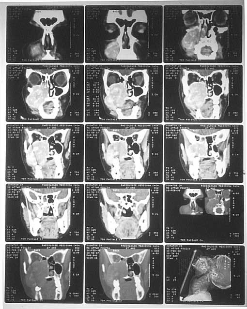 Fig. 4 :  Tomodensitométrie  de la face en coupe  frontale : processus  tumorale expansif du maxillaire gauche, hétérogène, comblant le sinus maxillaire, et la fosse nasale gauches, atteignant  l’ethmoïde avec lyse du plancher de l’orbite