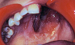 Fig. 6 a : Aspect post-opératoire : Vue endobuccale de la perte de substance maxillaire