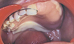 Fig. 6 b :   Prothèse obturatrice provisoire