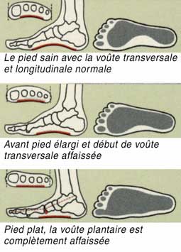 formes de pieds