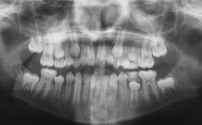 Fig.1 : Radiographie panoramique avant traitement 