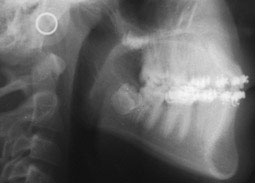 Fig. 10 : Radiographie de profil avant traitement