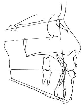 Fig. 11 : Analyse céphalométrique de fin de traitement 