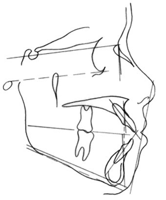 Fig. 3 : Analyse cephalométrique avant traitement