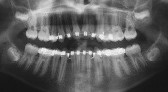 Fig. 9 : Radiographie panoramique avant traitement