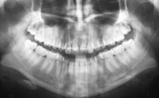 Fig. 35 : Radiographie panoramique 6 ans après la fin du traitement ODF.   