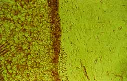 Fig. 2 : Premier stade d'inflammation de la pulpe : l'interruption de la couche odontoblastique (Service d'odontologie conservatrice).