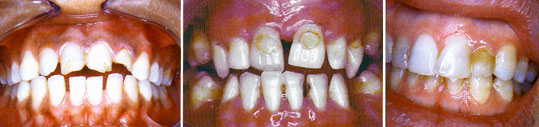 Fig. 8, 9, 10: Cas cliniques illustrant des composites défectueux