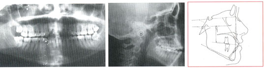 Fig. 2: Radio panoramique, téléradiographie de profil et tracé céphalométrique avant traitement