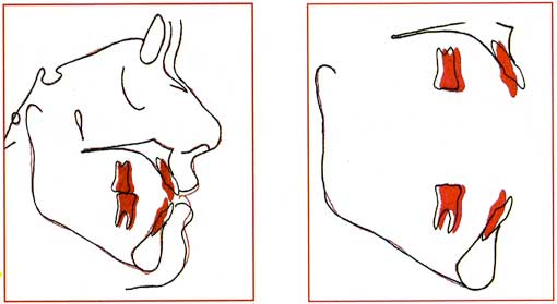 Fig. 5: Superposition générale et locale des tracés pré- et post-traitement