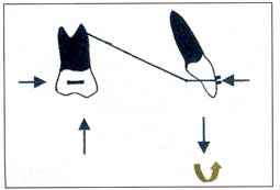 Fig. 6: Un "V-bend" antérieur produit des forces ingressives au niveau des molaires et egressives au niveau des incisives