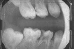 Fig. 3b : Rétrocoronaire du secteur droit. Noter la carie disto-occlusale à proximité pulpaire sur 54